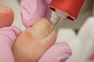 Ingrown Toenail Removal: At-Home Care vs Seeing a Podiatrist